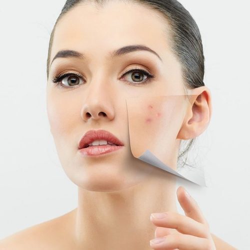 Skin needling